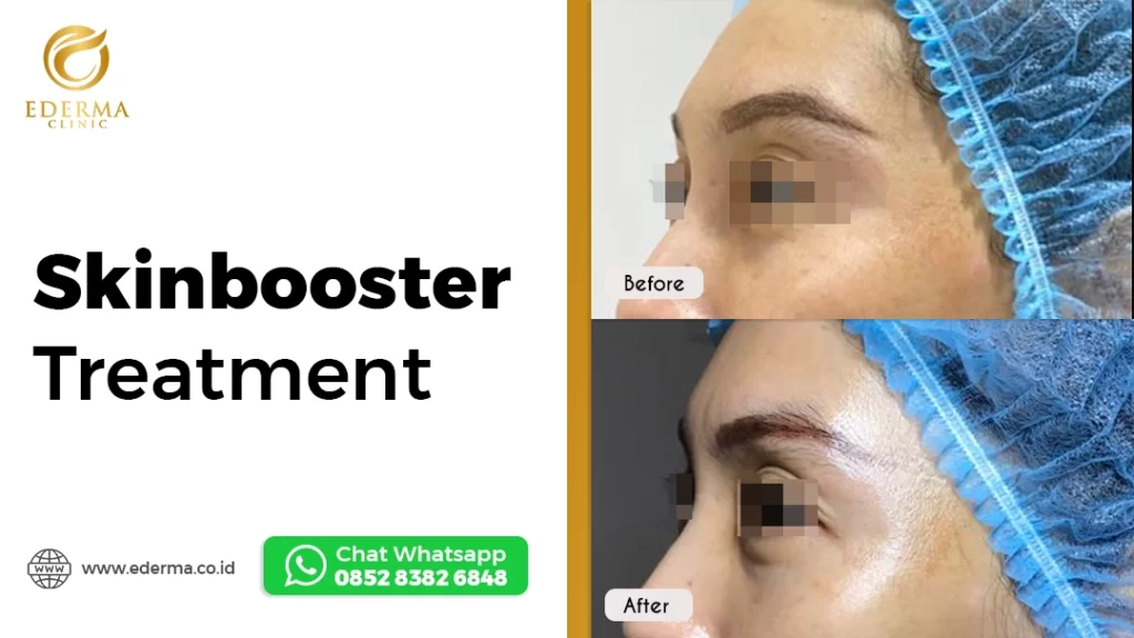 skinbooster