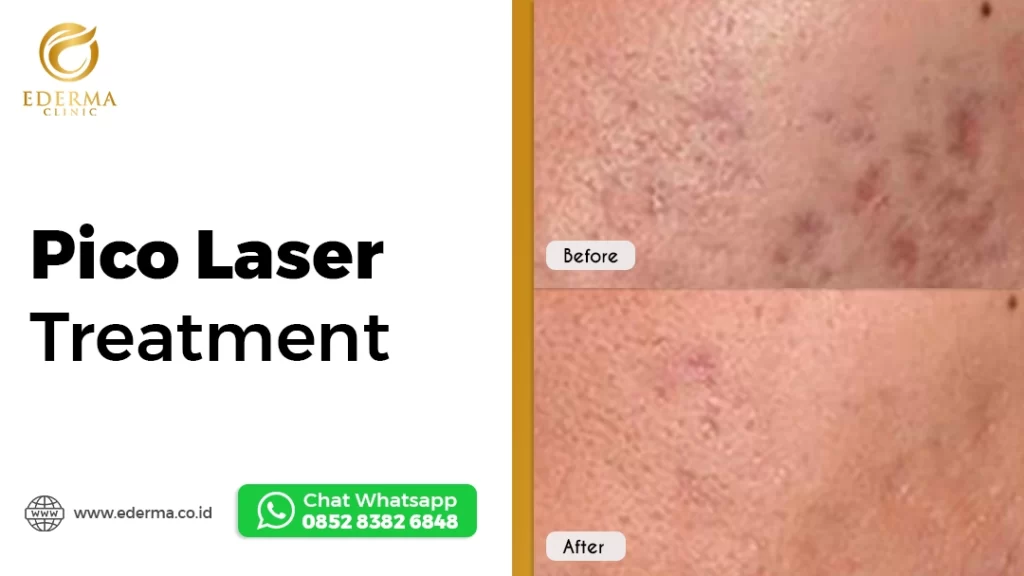 Laser Wajah Treatment Before After