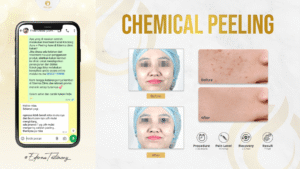 chemical-peeling-testimoni-ederma-clinic