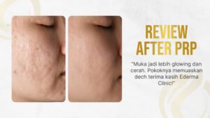 testimoni-prp-treatment-di-ederma-clinic