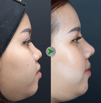Before After Rhinoplasty