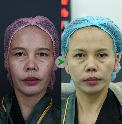 Before After - Facelift 001