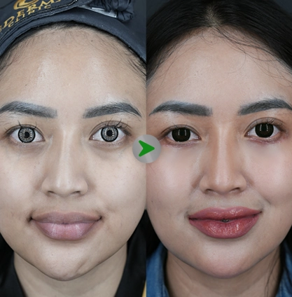 Before After - Lower Blepharoplasty 001